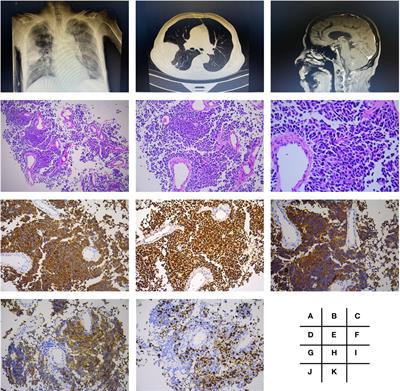 Case Report: Anti-TNF Treatment Failure in a Patient With Immune Checkpoint Inhibitor-Induced Severe Colitis